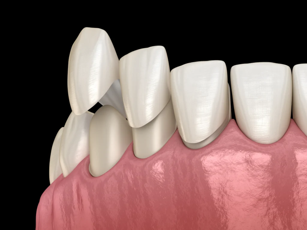 facettes dentaires veneers consultation dentiste facettes dentaires veneers consultation dentiste Soins esthétiques Cabinet dentaire NACRE, Dentistes à Saint-Jacques-de-la-Lande