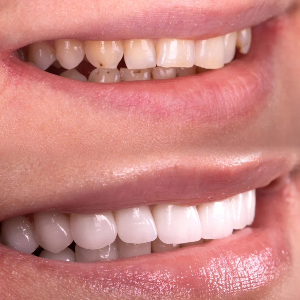 rennes facettes dentaires veneers rennes facettes dentaires veneers Soins esthétiques Cabinet dentaire NACRE, Dentistes à Saint-Jacques-de-la-Lande