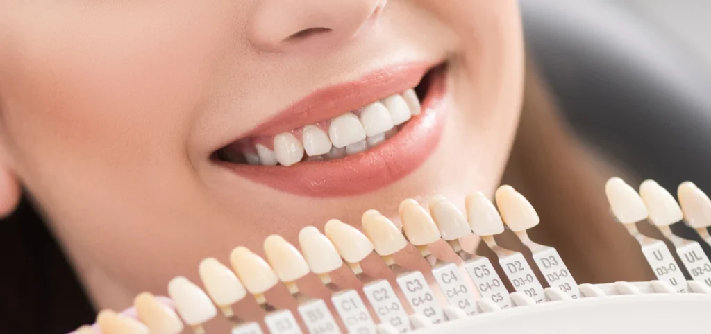 facettes dentaires Soins dentaires Cabinet dentaire NACRE - Dentistes à Saint-Jacques-de-la-Lande