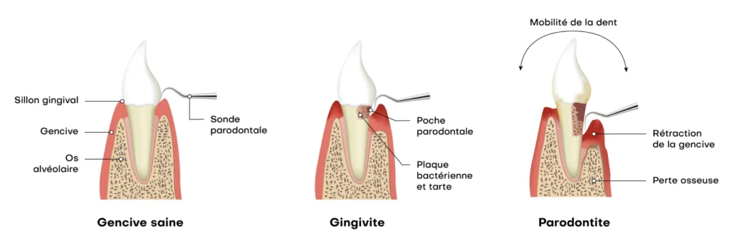 rennes soin gencives parodontologie Parodontite : la maladie des gencives Cabinet dentaire NACRE, Dentistes à Saint-Jacques-de-la-Lande