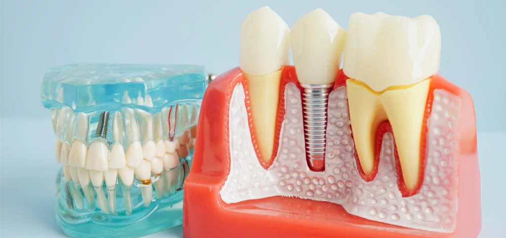 implant dentaire rennes implant dentaire rennes Soins dentaires Cabinet dentaire NACRE, Dentistes à Saint-Jacques-de-la-Lande
