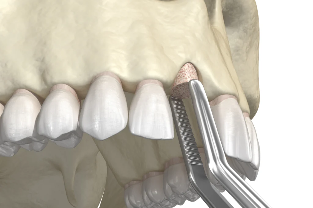 greffe osseuse chirurgie orale rennes Soins chirurgicaux des gencives Cabinet dentaire NACRE, Dentistes à Saint-Jacques-de-la-Lande