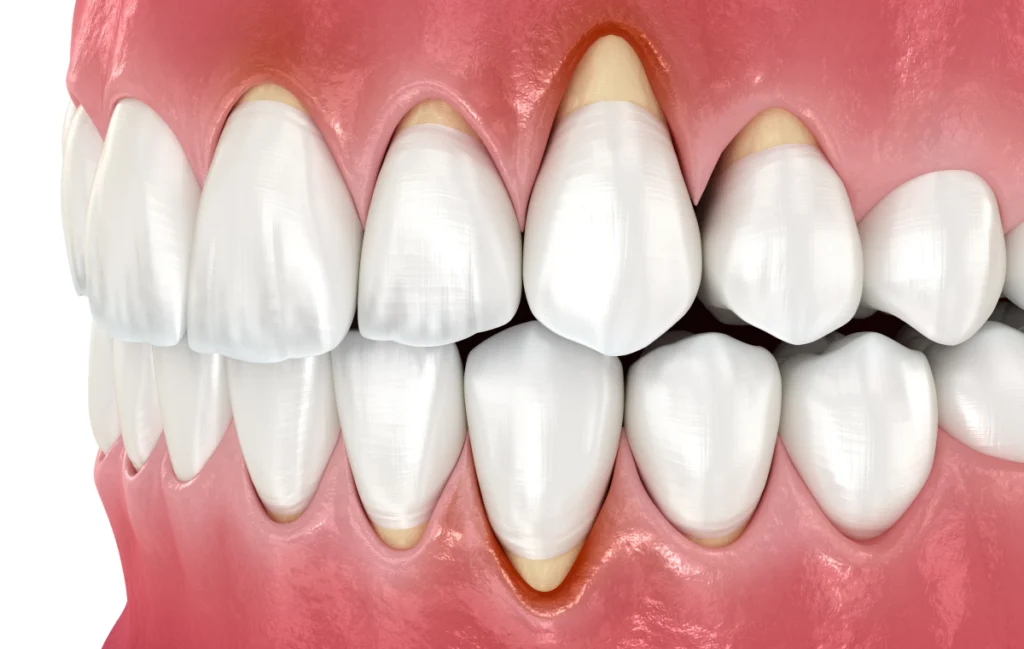 greffes gencive soin dentaire rennes Soins chirurgicaux des gencives Cabinet dentaire NACRE, Dentistes à Saint-Jacques-de-la-Lande