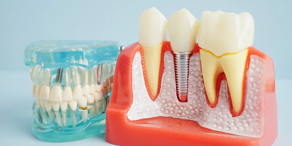 implant dentaire Implants dentaires Cabinet dentaire NACRE - Dentistes à Saint-Jacques-de-la-Lande