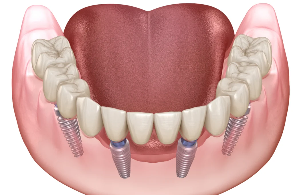 implant dentaire complet all on Implants dentaires Cabinet dentaire NACRE - Dentistes à Saint-Jacques-de-la-Lande