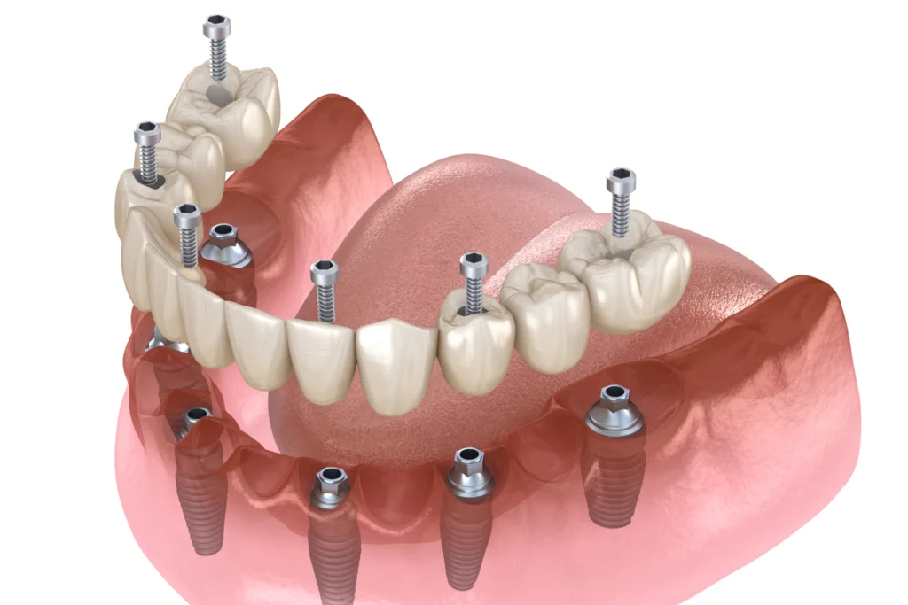 implant dentaire complet dentier Implants dentaires Cabinet dentaire NACRE - Dentistes à Saint-Jacques-de-la-Lande