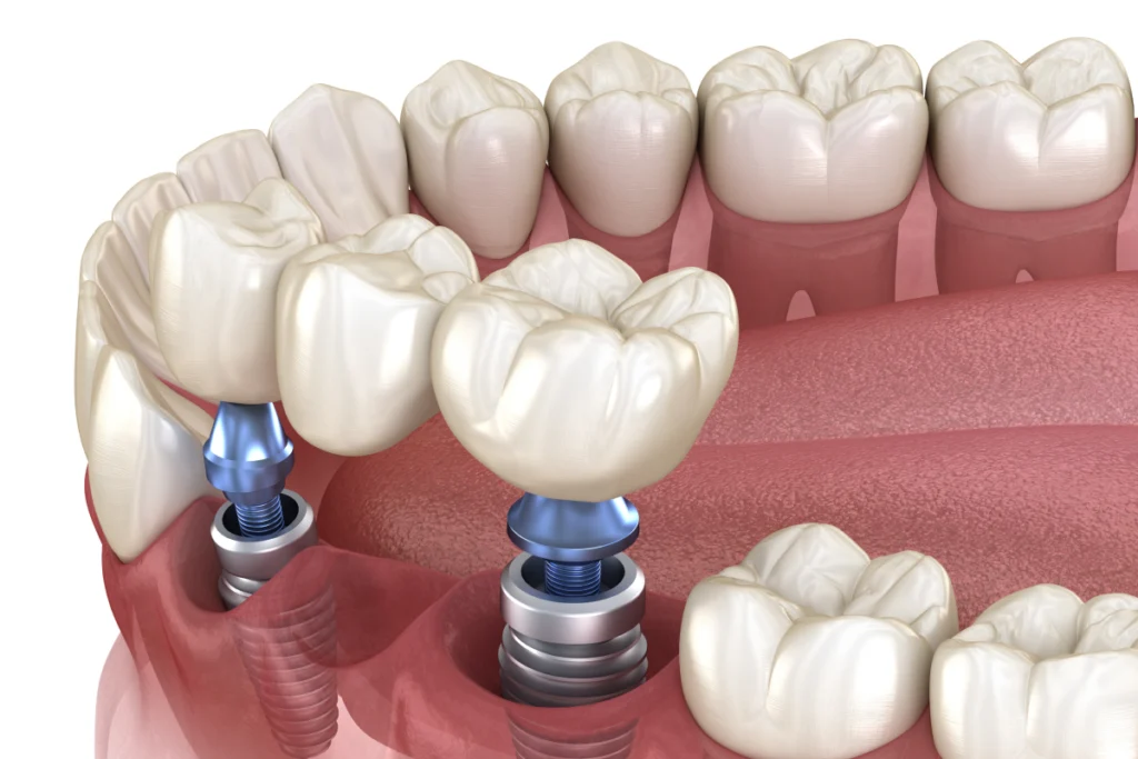 implant dentaire couronne bridge Implants dentaires Cabinet dentaire NACRE - Dentistes à Saint-Jacques-de-la-Lande